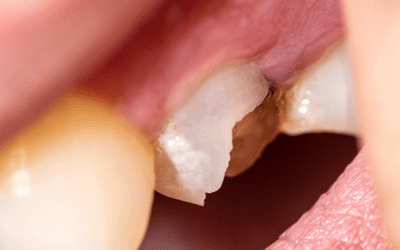 Chipped Tooth Katy: 1 Expert Repair and Restoration at Mason Dental